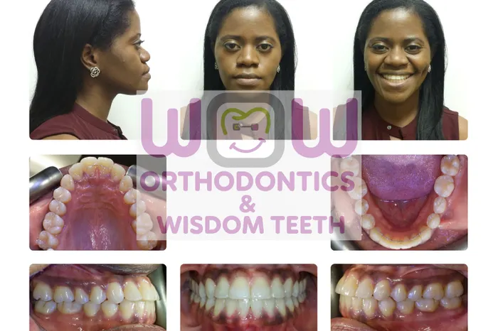 Crossbite Correction - After Crossbite Correction - After