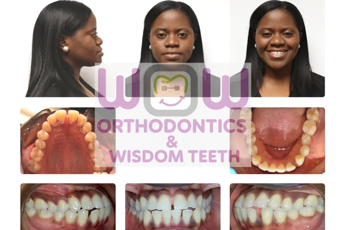 Crossbite Correction - Before Crossbite Correction - Before